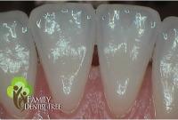 picture using intra-oral camera