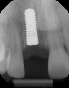 X-ray of dental implant