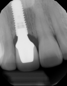 x-ray of a dental implant with a crown attached