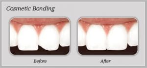 cosmetic-bonding