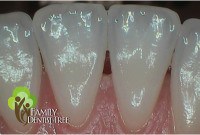 intraoral camera shot of teeth