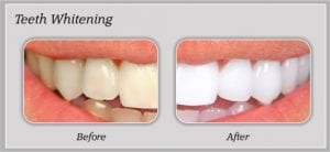 teeth-whitening