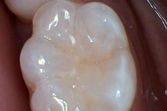 molar top