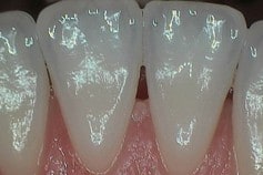 back of lower front teeth