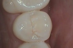 tooth before filler