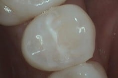 tooth with filler