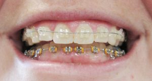 braces