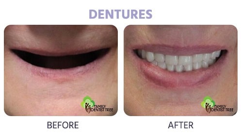 denture before and after