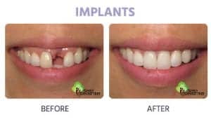 dental implant example