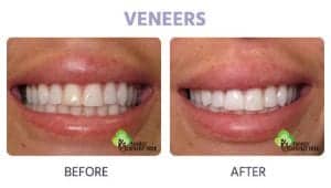 veneers for discoloration