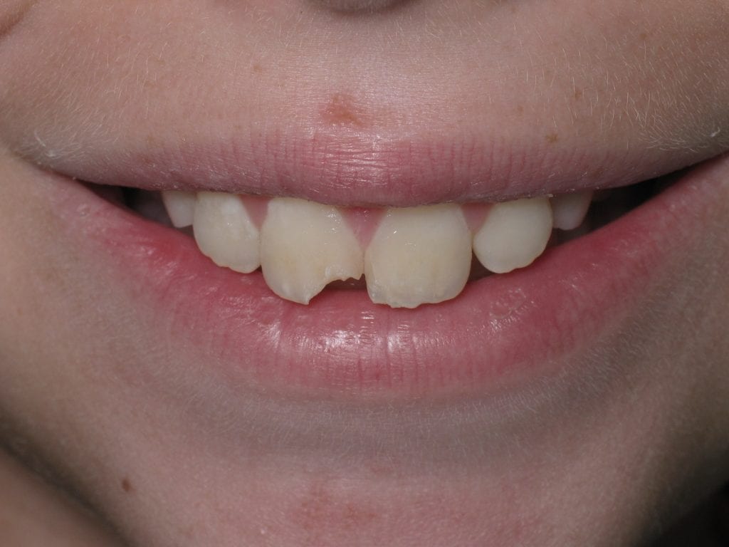 Chipped Tooth Blog Pic